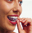 Invisalign