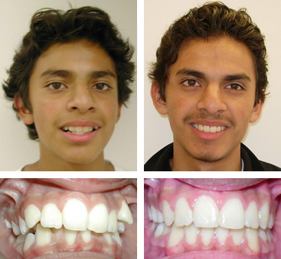 Before and after treatment photos of a patient