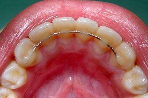 retainers