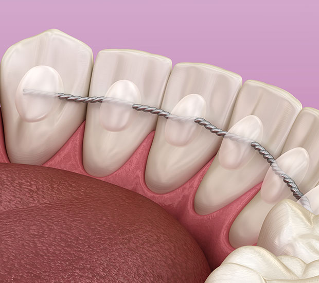 Los Angeles Fixed Retainers